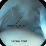 Rotator cuff tear