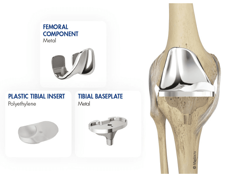 http://www.phongtran.com.au/wp-content/uploads/2020/08/Medacta-Total-Knee-Replacement.png