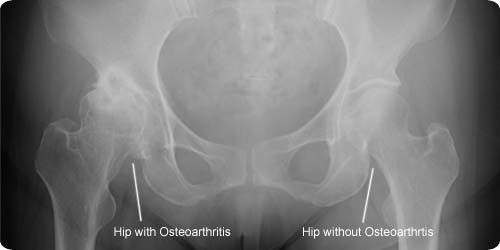 xr-hip-oarhip-ap-500-label02