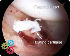 Loose fragements found in hip arthroscopy