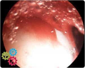 Severe hip inflammation seen on hip arthroscopy