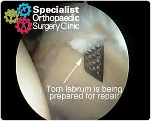 Labral tear seen on hip arthroscopy