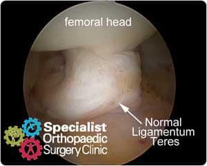 Normal ligametum teres seen on hip arthroscopy