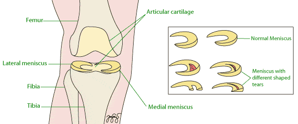 Meniscal Tear