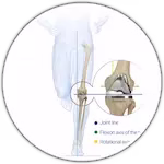 Muscle Sparing Joint Replacement - Melbourne