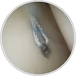 key hole arthroscopy melbourne